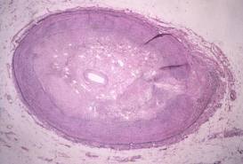 Arteria con Arterioesclerosis, Practicamente no hay circulacion sanguinea, por la escasa luz del interior de la arteria.