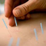 acupuntura