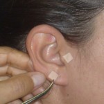 auriculoterapia